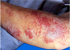 皮肤瘙痒有哪些病因？